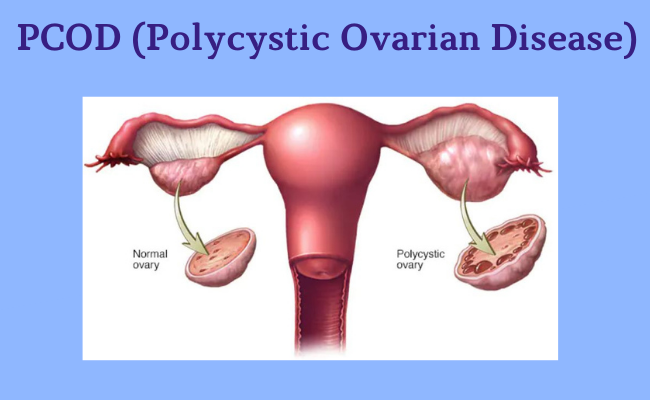 PCOD Treatment